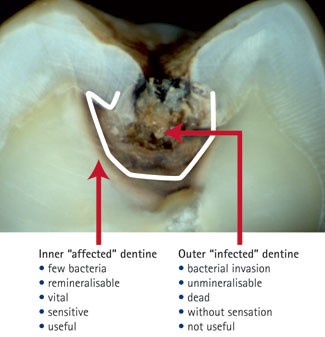 Toothache After Filling – Why? - B & F Dental Clinic Singapore